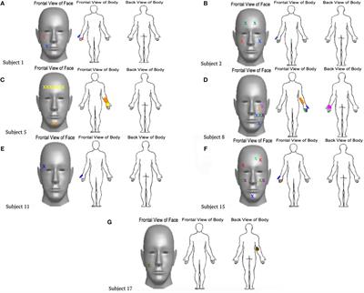 Hand-to-Face Remapping But No Differences in Temporal Discrimination Observed on the Intact Hand Following Unilateral Upper Limb Amputation